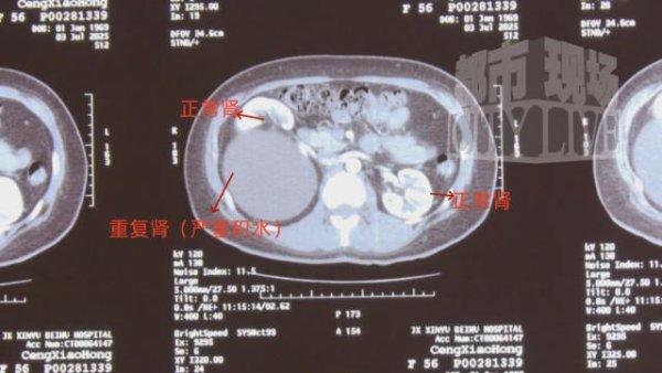 胜宇配资 江西一女子长期腰痛，去医院检查竟有三个肾！医生：概率仅为千分之五